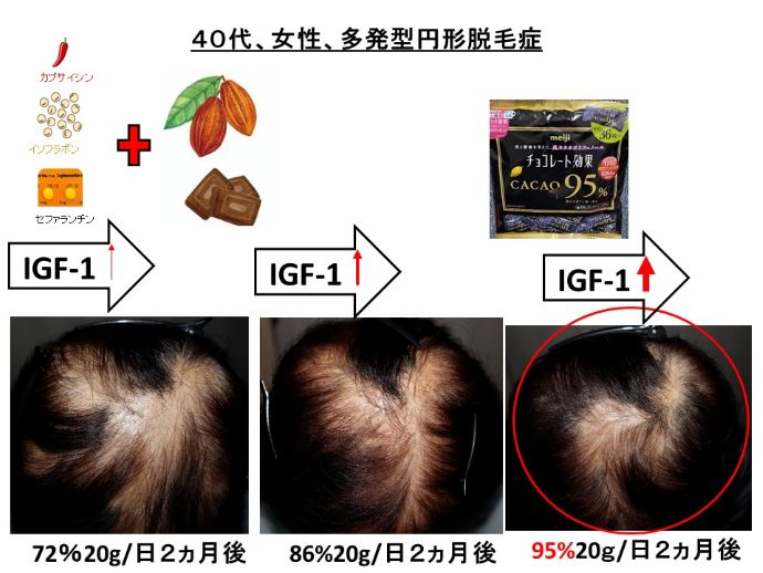 円形脱毛症　病院